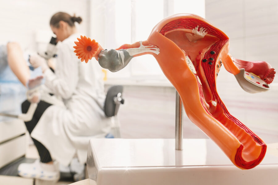 Endometriose